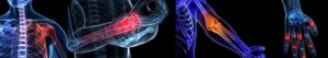 Stress areas of the body using conventional crutches